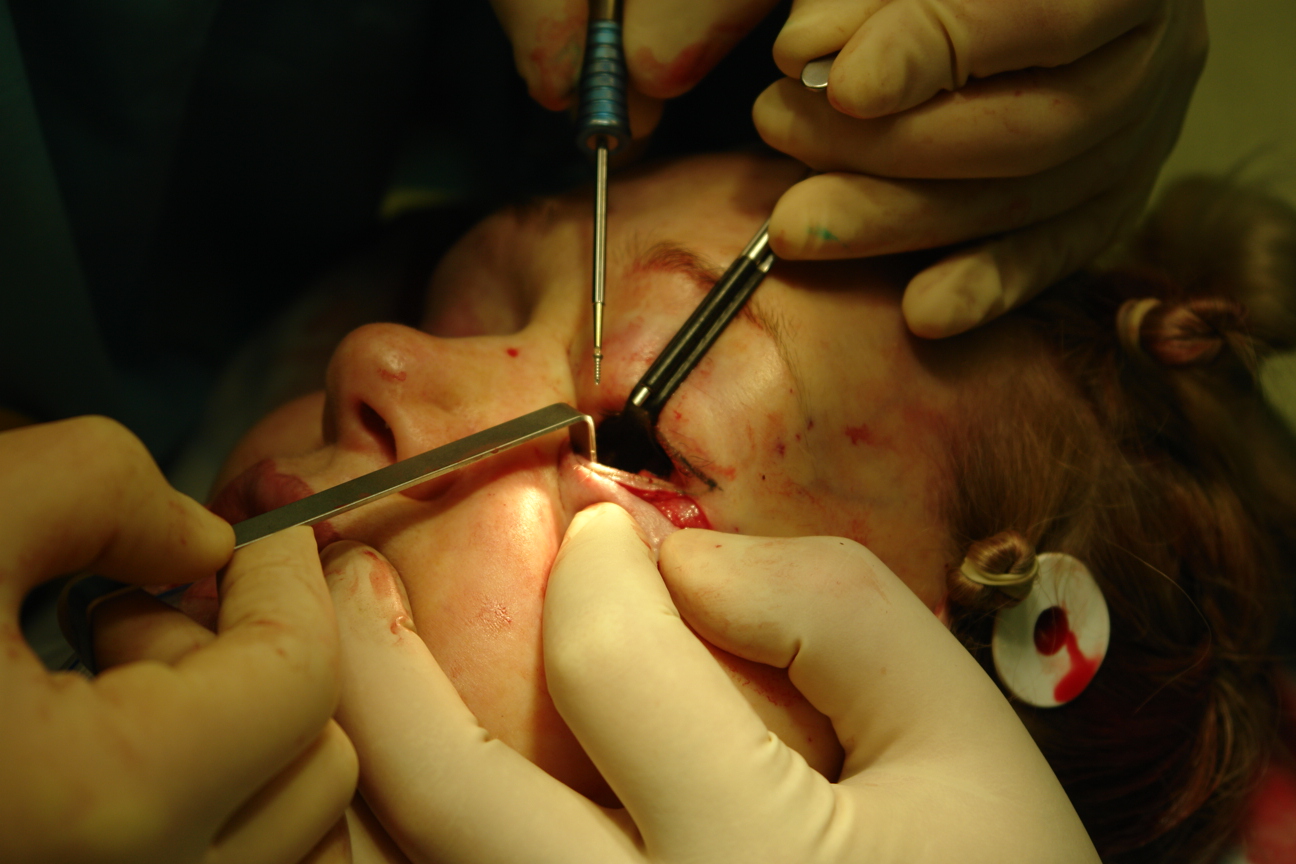 Фиксация  имплантата микрошурупом из трансконъюктивального доступа.
